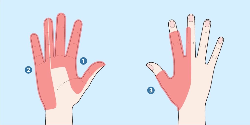 手指のしびれの部位を示した手のひら、手指のしびれの部位を示した手の甲