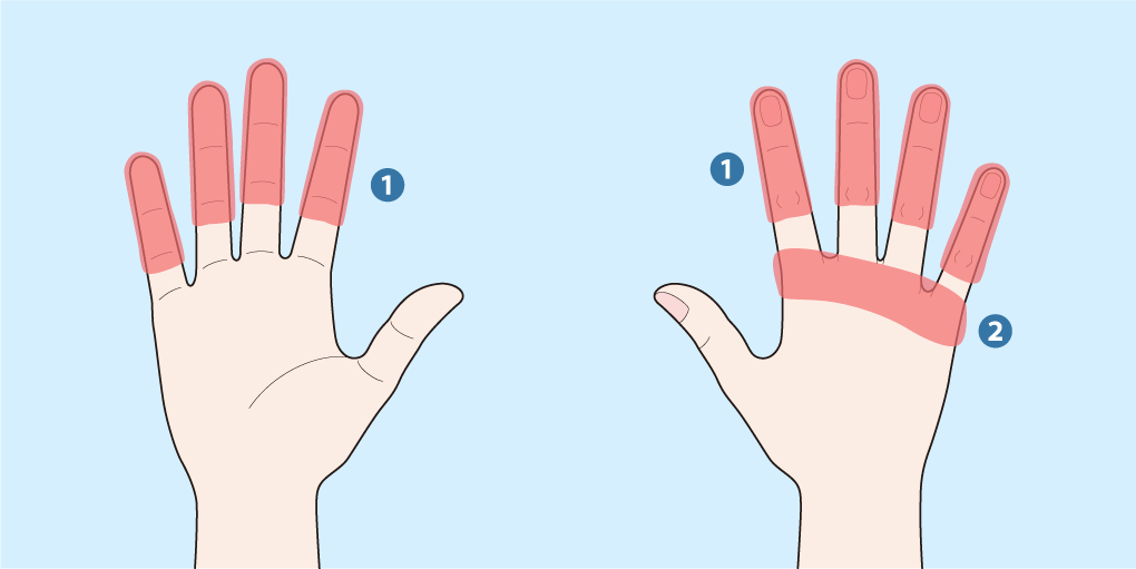 関節リウマチの手疾患の部位を示した手のひら、関節リウマチの手疾患の部位を示した手の甲