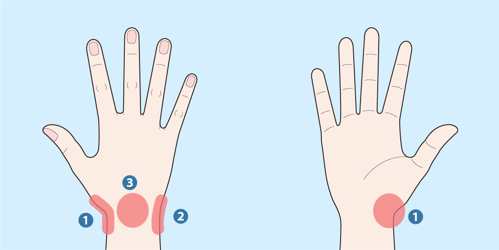 手首の痛みや腫れの部位を示した手の甲、手首の痛みや腫れの部位を示した手のひら